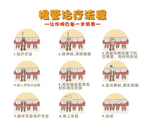 根管治疗流程