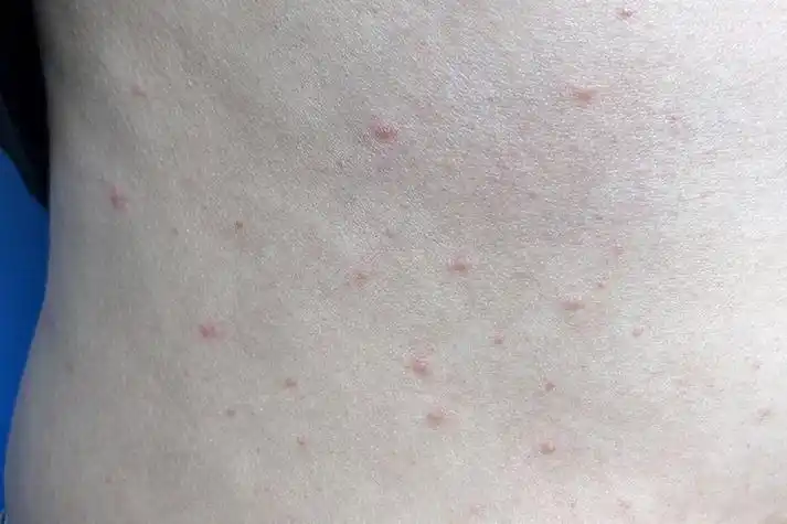 综合征期和临床艾滋病期,通常在急性感染期内会出现初期小红点的症状