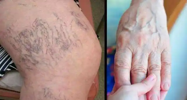 有些人手臂"青筋暴起",有些人却看不到"青筋",医生给你科普|血管|肌肉