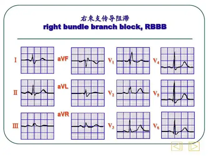 心电向量图基础ppt
