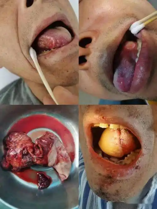 口腔溃疡莫小视,常德市二医院专家提醒:警惕舌癌!
