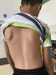 掌握自查方法尽早发现青少年脊柱侧弯