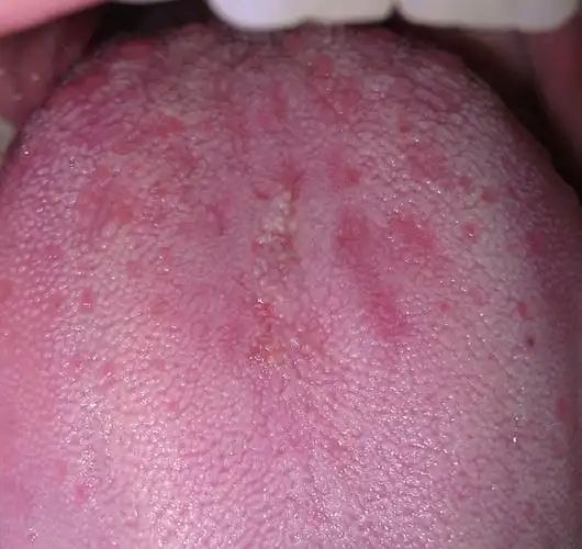 舌头起泡可以进行手术切除,在门诊进行局部麻醉就可以切除黏液腺囊肿