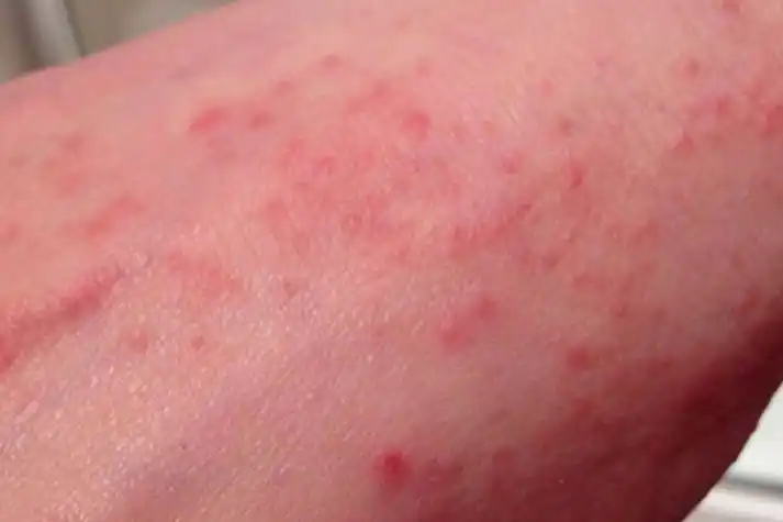 艾滋病初期小红点照片