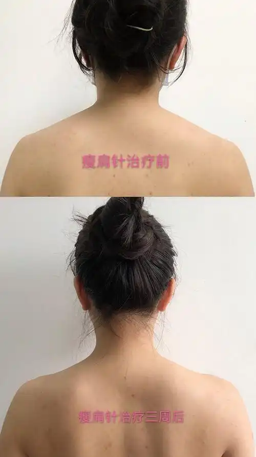 瘦肩针的神奇 - 好大夫在线
