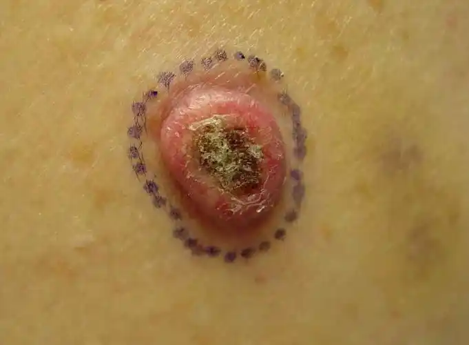 这4种皮肤早期表现多半是皮肤癌你应该要知道