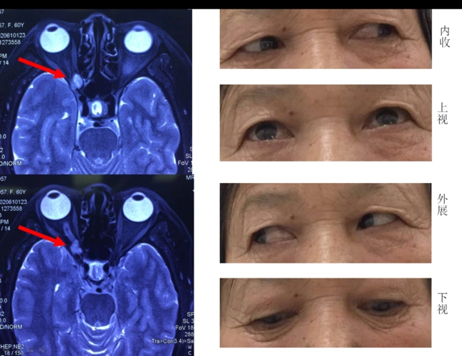 神经内镜下经鼻切除眼眶内肿瘤 - 好大夫在线
