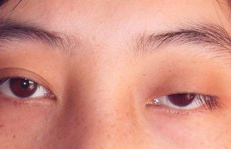 没睡醒所以眼睛睁不开,没有那么简单,小心是眼肌型重症肌无力