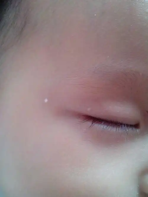宝宝眼角长了两个白色疙瘩(图),快五个月了不下去,有宝妈知道是怎么