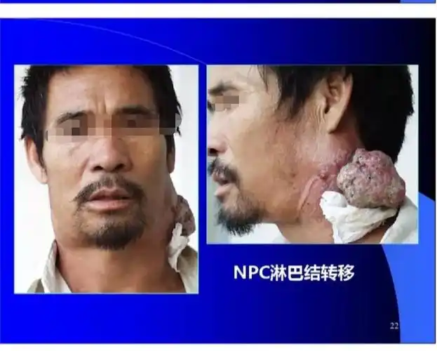 鼻咽癌可无症状或症状轻微,易被患者忽略,部分患者以颈部淋巴结肿大或