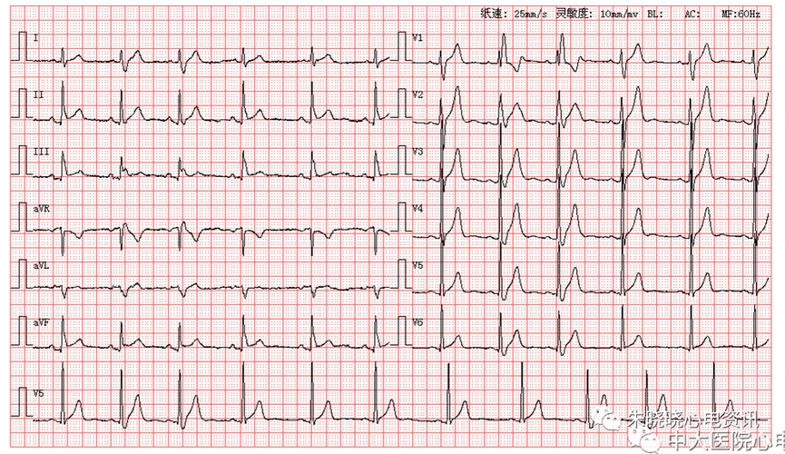 每日读图|第1532期 交界性早搏