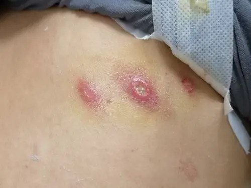 糖尿病对皮肤的危害虫咬皮炎要当心