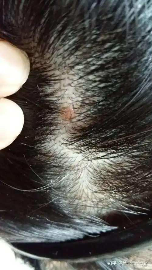 夏天温度高头皮上皮肤出痛包那是毛囊炎就会出来非常痒痛用什么能快点