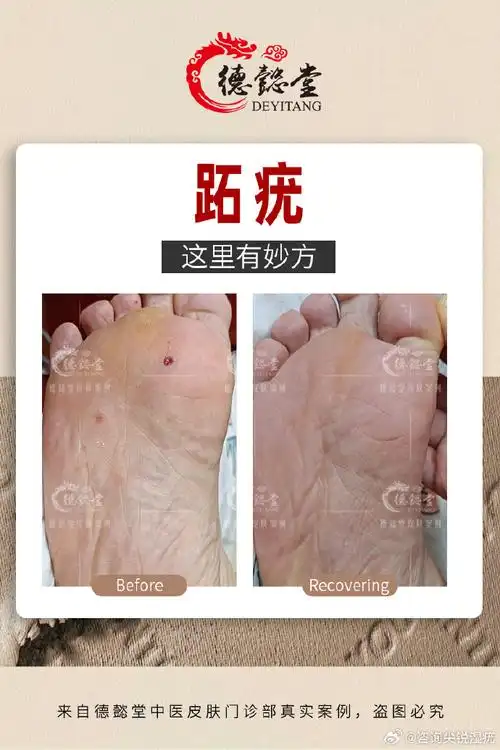 经朋友介绍前来治疗跖疣,目前已痊愈,可喜可贺!#跖疣