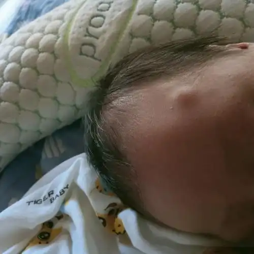 请问大家有这样的吗,b超做了,大概率是皮脂腺囊肿