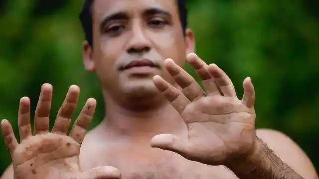 6根手指你见过但长成这样的你见过吗