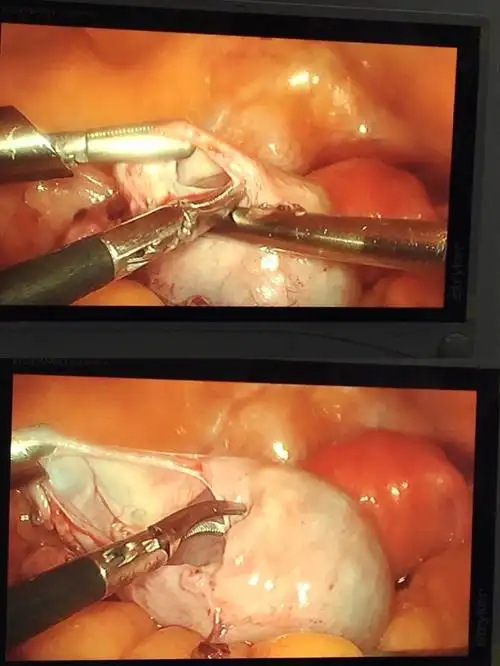 黄石市中医院妇产科腹腔镜下卵巢囊肿剥离术一例(副本)