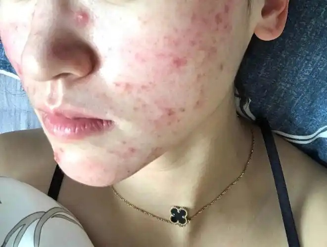 生完孩子后一直面部丘疹用过一段时间的尤卓尔后一直有炎性丘