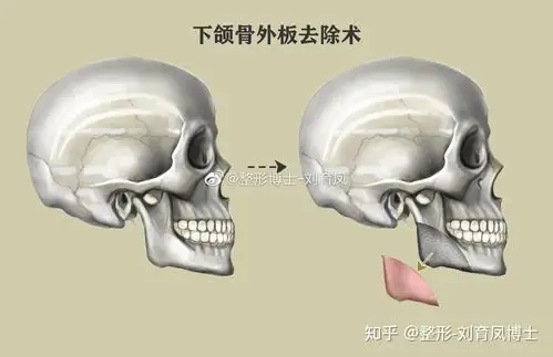 关于下颌角几种截骨方式的选择