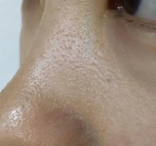 脸颊两鸡皮肤(脸颊鸡皮肤泛红)