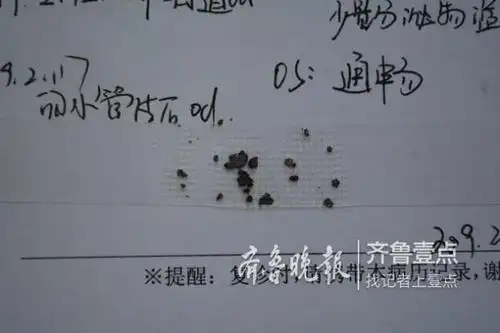 泪道取出50多颗结石!这种眼病症状与结膜炎相似
