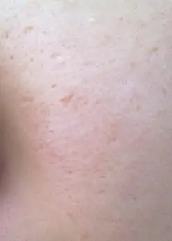 还越长越多和越长越大!以后会不会毁容啊?附图!