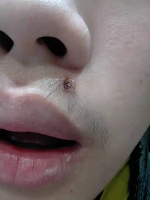 激光去痣后两天,这样子正常吗,不正常的话要怎么办