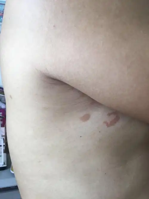 的腋窝下面一点的皮肤变的有点红,不痛也不痒,不知道是不是得了什么病