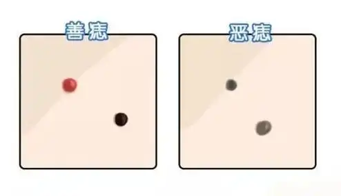 鼻翼长痣,难以守财?