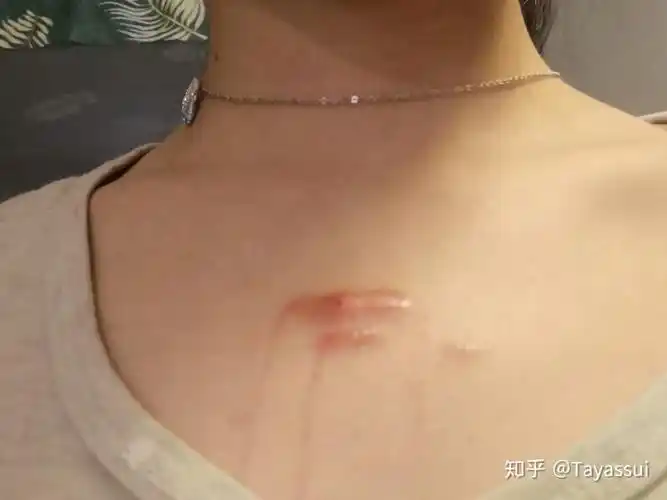 胸前长了六年之久的疤痕增生影响生活及心情