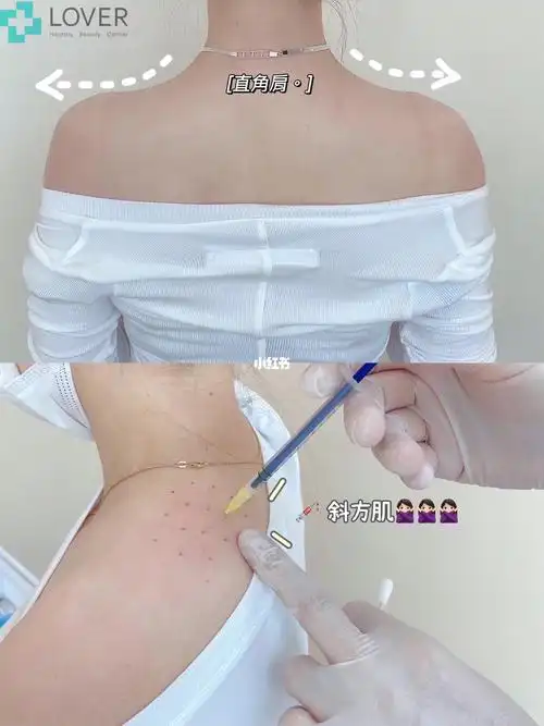 【 botox · 瘦肩針】 天氣熱起來了,如果您對自己的肩膀不是很滿意