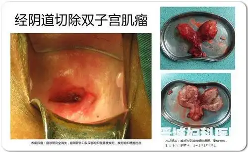 经阴道切除子宫禁忌症1,宫颈癌或其它盆腔恶性肿瘤者.