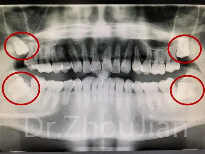 奇葩智齿大揭秘