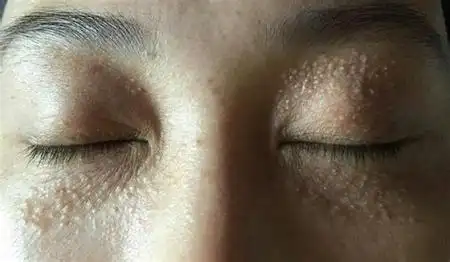 脂肪粒图片眼部图片