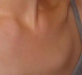 锁骨正中间下面的骨头突出 21 2011-07-21 右锁骨胸骨端最近发现突出