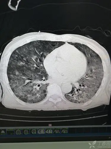 胸部ct白肺