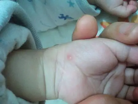 问:我家小孩一岁多手上突然长了这个小水泡.应该是痒他会去抓.