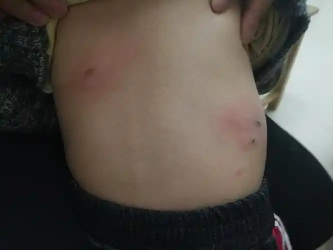 宝宝虫咬皮炎特征 - 好大夫在线