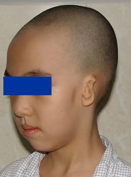 单侧咀嚼,何止脸会歪