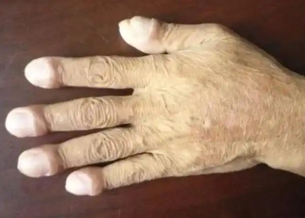 出现"杵状指",是肺癌的信号吗?不排除这种可能,但没那么简单