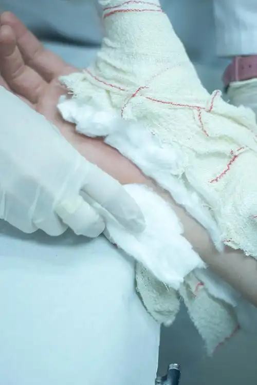 骨折后,医生在患者前臂和手腕上使用石膏石膏和绷带固定.图片下载