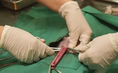 探究包皮过长手术费用 治疗方法有哪些