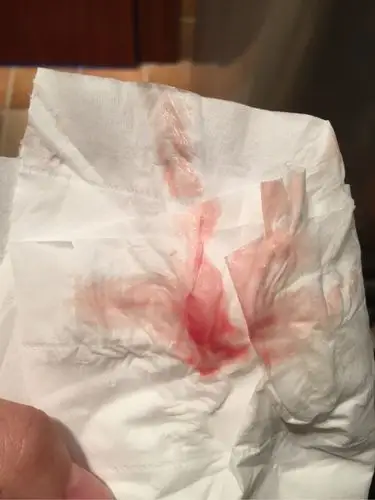 移植23天又出血了,会是宫外孕吗?