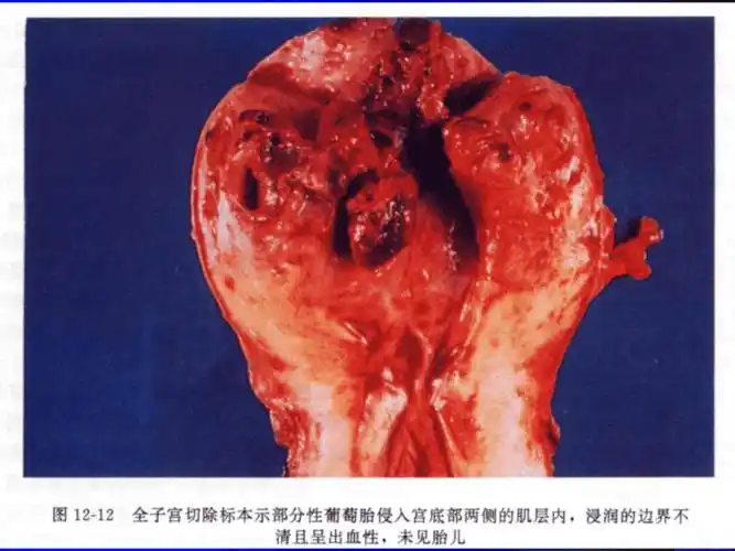 侵蚀性葡萄胎ppt