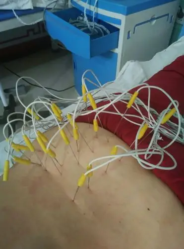 针对臀部肌肉的针刺