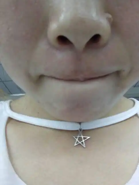 鼻子旁边长了一个肉疙瘩,想知道是不是泪痦,该问谁呢?