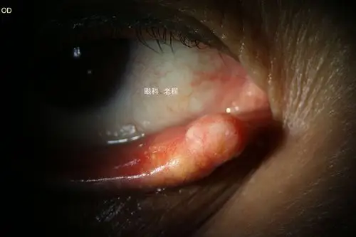皮脂腺癌(周月琴 · 结膜 · 肉芽).jpg