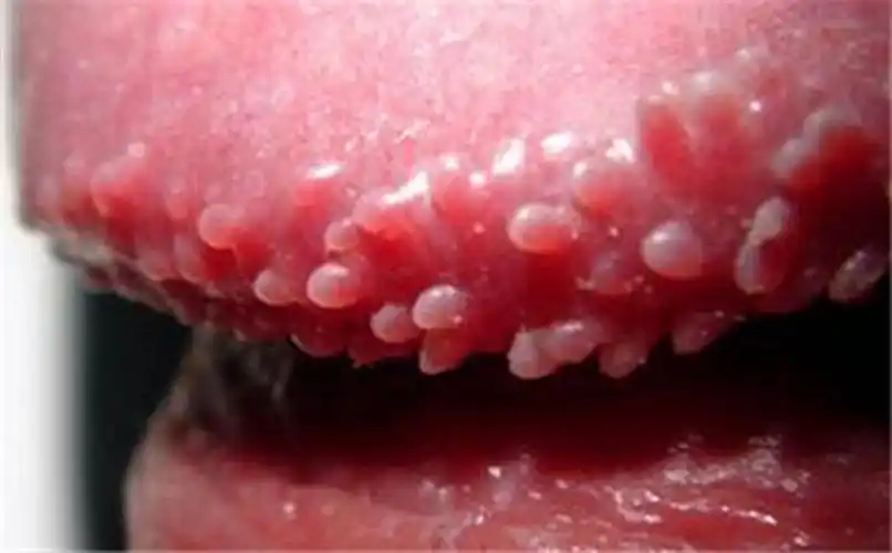 男性包皮尖锐湿疣图片_有来医生