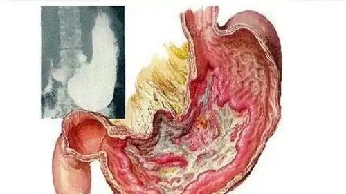 浅表性胃炎, 伴糜烂, 胃溃疡? 老中医"两味药"去根儿!