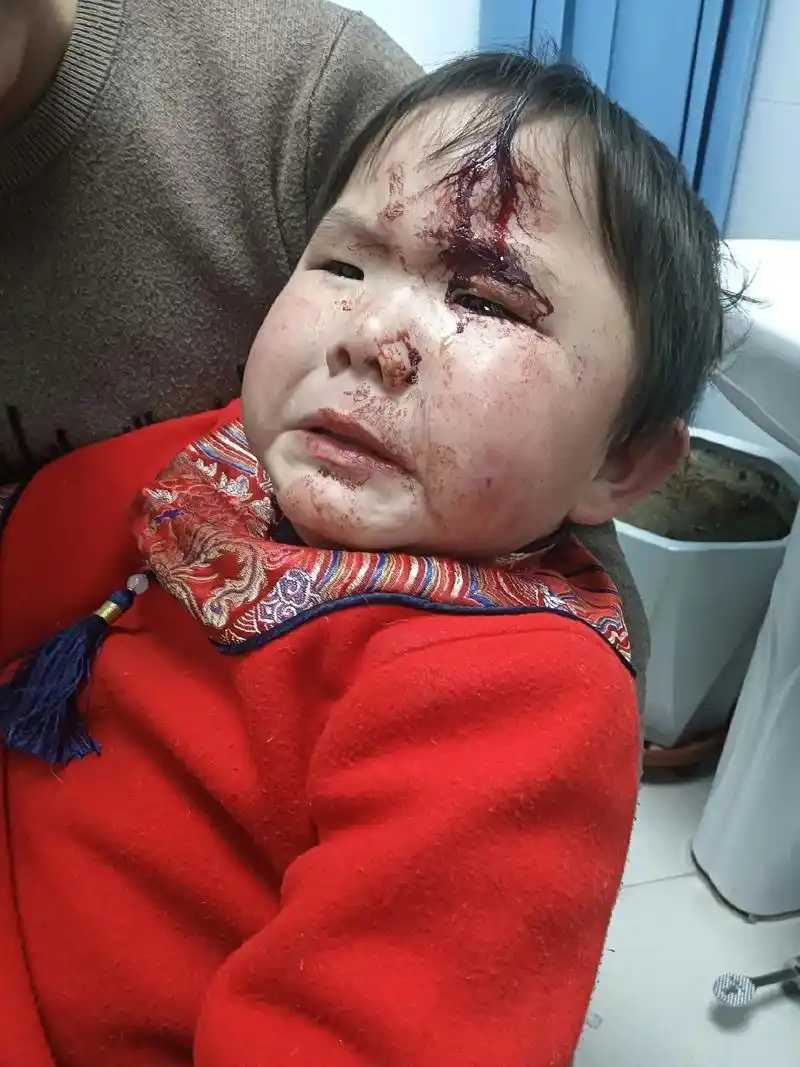 本来高兴的一天,晚上却发生了意外(额头不小心磕破缝了五针)… - 抖音